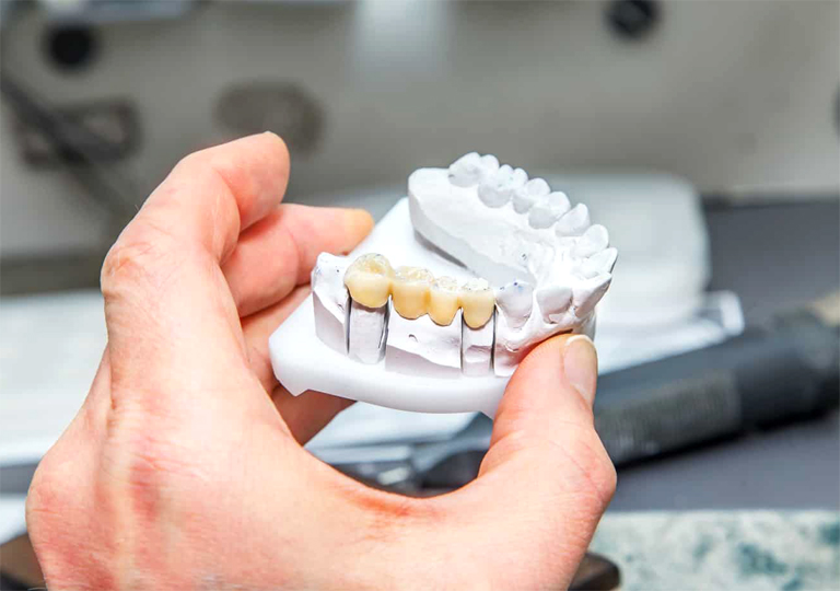 Céramiques Dentaires Dental Plus